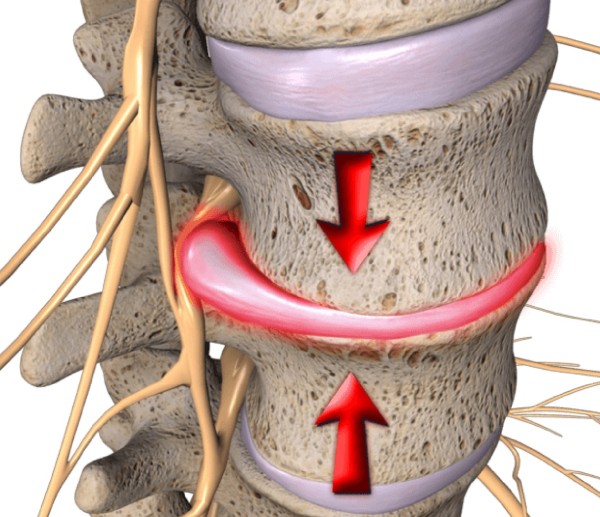 Pinched Nerve - Advanced Wellness Clinic